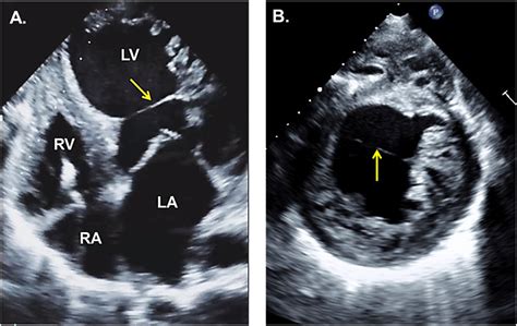 left ventricular false tendon